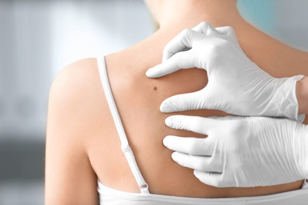 Skin Biopsies