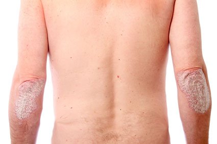 psoriasis
